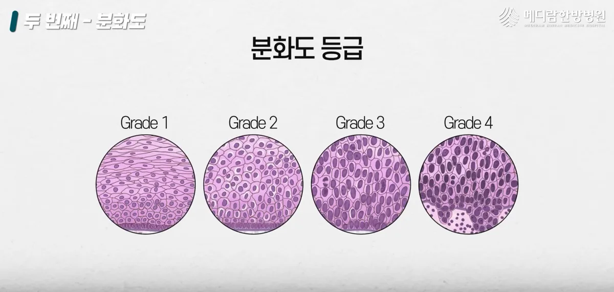 병리 조직검사에서 확인하는 분화도 등급을 설명하는 자료 화면